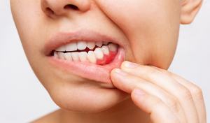 Image showing gum disease. 