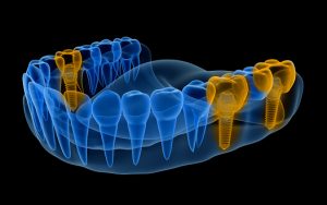 X-ray of a multiple tooth implant.