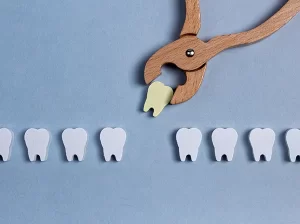 Fake model, showing how a tooth is removed. 